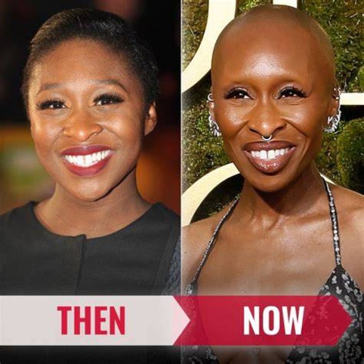 Cynthia Erivo and Her Battle with Alopecia Areata: A Comprehensive Guide