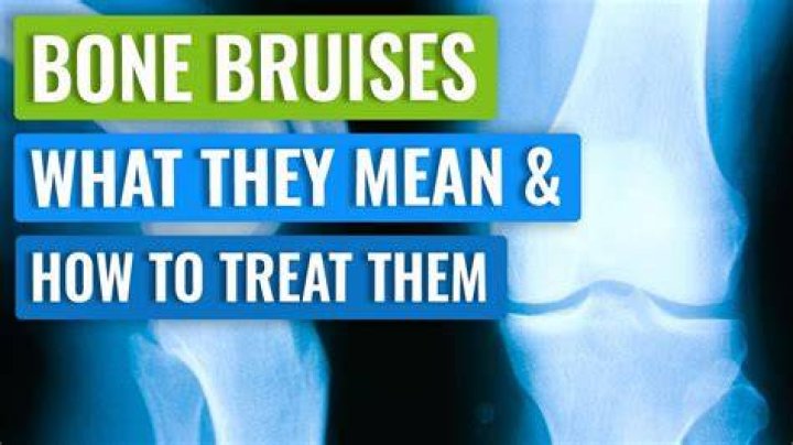Exploring "Bonnie Bruises": More Than Just a Scratch