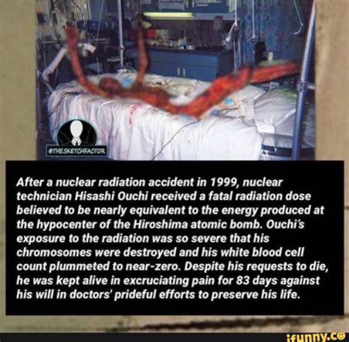 Hisashi Ouchi Real: The Tragic Story of Unthinkable Radiation Exposure