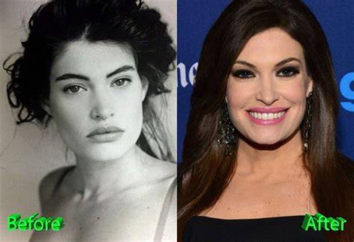 Kimberly Guilfoyle's Plastic Surgery Journey: A Comprehensive Overview