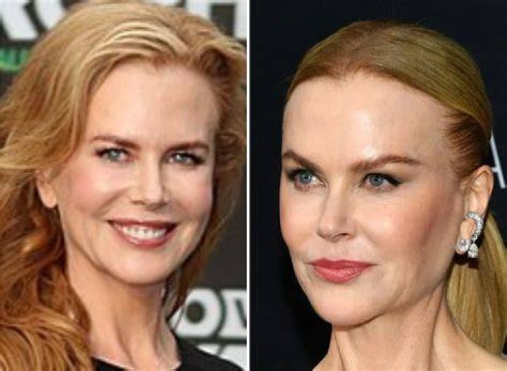 Nicole Kidman Plastic Surgery: A Comprehensive Look at Her Transformation and Choices