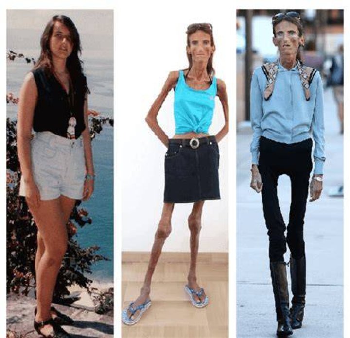 The Remarkable Story of the Skinniest Person in the World