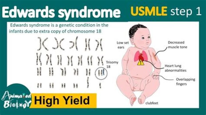 Understanding Edward Bluemel Syndrome: Causes, Symptoms, and Treatment Options