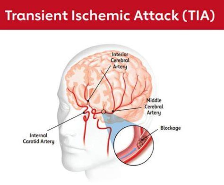 Understanding TIA (Transient Ischemic Attack) Beyond 'Tia Kemp Wikipedia' Searches